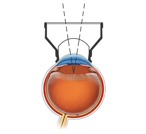YAG Capsulotomy Lens — şəkil 2
