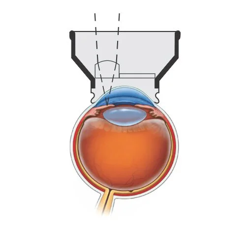 YAG Iridectomy Lens — şəkil 3