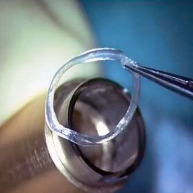 Keratoplasty & Cornea — şəkil 2