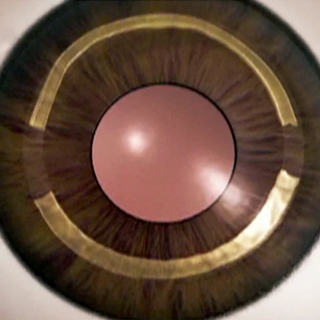 Keratoplasty & Cornea — şəkil 3